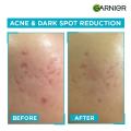 GARNIER Anti-Acne Serum (With 4% Vitamin C + Salicylic + Niacinamide + Aha To Fight Acne And Fade Dark Spots) 30Ml. 