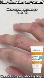 DermaBalm ECZEMA RASHES ITCHING Cream - 50g Soothes & Relieves Irritated Skin Moisturizing
