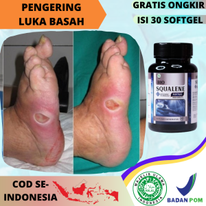 Obat Buat Luka Diabetes Luka Diabetes Basah Membantu Menyembuhkan Luka Diabetes Menhun Tipe 1 2 3 Tanpa Operasi Obat Luka Diabetes Yang Bernanah Agar Kering Luka Gangren Diabet Tradisional Alami Infeksi Luka Berdarah - Bio Squalane Isi 30 Softgel