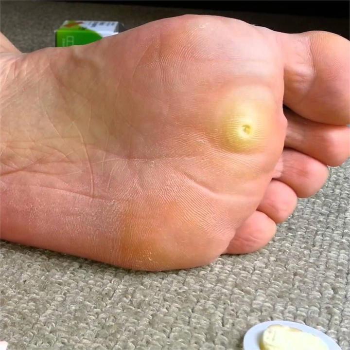 Plester Kutil Mata Ikan untuk Kaki Kapalan Foot Corn Removal Plaster Koyo Penghilang Mata Ikan12pcs plester mata ikan,obat mata ikan di telapak kaki,plaster mata ikan