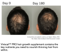 💯Viviscal Pro / Professional 180 pills Hair Loss Supplement for Hair Growth 3 Months Supply *2 Days Delivery*. 