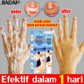 1 hari sembuh KADAI Salep Vitiligo 100% menghilangkan Menghambat Pertumbuhan Kulit Putih mengaktifkan melanin Meratakan Warna Kulit Untuk tubuh dan wajah formula jamu Tidak melukai kulit(vitiligo cream obat salep vitiligo vitiligo obat). 