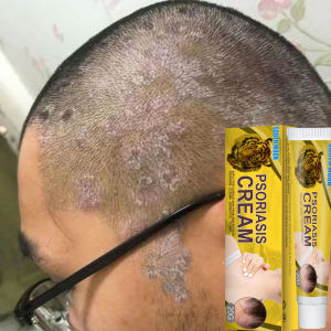  Kem bôi nấm ngứa vẩy nến hắc lào mề đay á sừng viem da nấm da