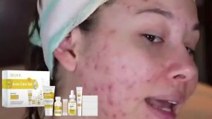 【Ready Stock】 EELHOE 3-in-1 Purifying Skincare Set – Face Wash Gel Hydrating Serum & Spot Cover Patch for Oily Skin Daily Skincare Routine 60ml+30ml+1pc
