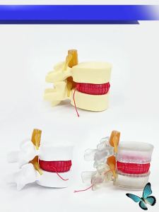 LZD  Mô Hình Trình Diễn Áp Lực Lên Đĩa Đệm Thắt Lưng Của Con Người Mô Hình Phóng Đại Cột Sống Thắt Lưng