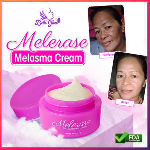 Melerase Melasma Cream Pekas Remover Original 12k Sold Best Selling Melasma and Pekas Treatment
