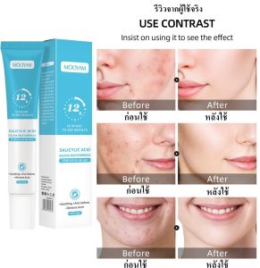 เจลแต้มสิวกรดซาลิไซลิก 20g รอยสิวแลดูจางลง  ปิดรูขุมขน รูขุมขนหดตัว เจลต่อต้านสิวสารสกัดจากพืช