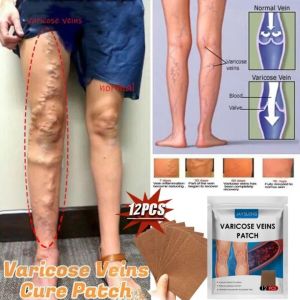 Miếng dán Varicose Veins Patch_Khắc tinh suy giãn tĩnh mạch