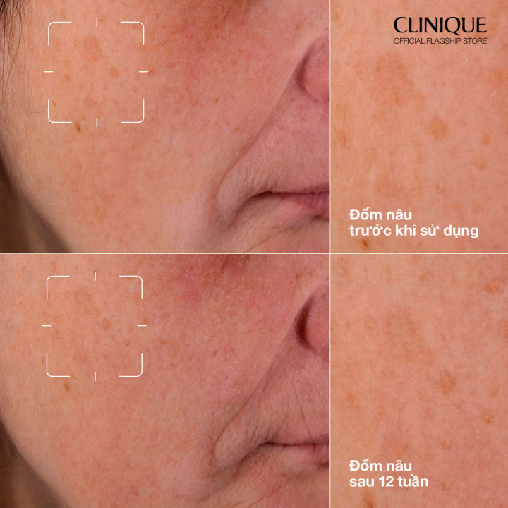 Serum%20d%C6%B0%E1%BB%A1ng%20s%C3%A1ng%20da%20Even%20Better%20Clinical%E2%84%A2%20Dark%20Spot%20Clearing%2030ml,%2050ml,%2075ml%20l%20l%C3%A0m%20s%C3%A1ng%20da,%20gi%E1%BA%A3m%20%C4%91%E1%BB%91m%20n%C3%A2u,%20c%E1%BA%A3i%20thi%E1%BB%87n%20da%20b%E1%BB%8B%20x%E1%BB%89n%20m%C3%A0u%20v%C3%A0%20v%C3%A0ng%20da%20-%20Image%206