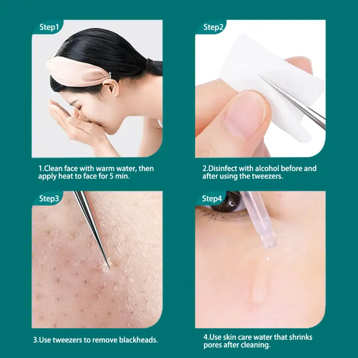 Blackhead%20Remover%20Tweezers,%20Blackhead%20Remover%20Comedone%20Extractor%20Stainless%20Steel%20Precision%20Pimple%20Popper%20Tool%20for%20Whitehead%20Acne%20Blemishes%20-%20Image%204