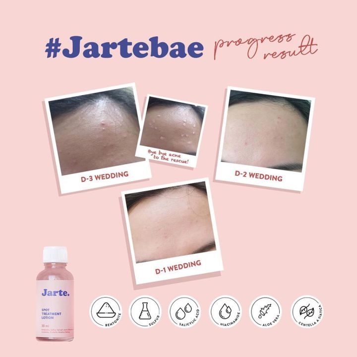 Jarte%20Beauty%20Bye%20Bye%20Acne%20Spot%20Treatment%20Lotion%20Share%20In%20Jar%20-%20Image%203