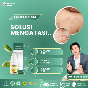 Obat Cacar Obat Cacar Air Anak Dan Dewasa Obat Cacar Monyet Obat Cacar Api Obat Gatal Cacar Air Ruam Perih dan Gatal Obat Koreng Bernanah Kudis Dengan Propolis SM