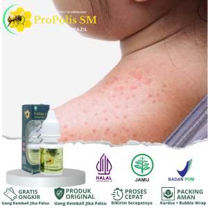 Obat Biang Keringat Obat Bintik-Bintik Merah Di Badan Obat Bruntusan Obat Gatal Kulit Karena Biang Keringat Obat Herbal Biang Keringat Aman Untuk Anak Dan Dewasa Dengan ProPolis SM
