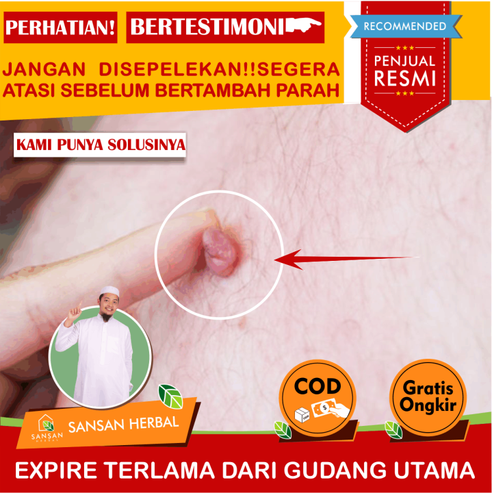 Obat Daging Tumbuh Di Kulit Salep Penghilang Daging Tumbuh Obat Daging Tumbuh Obat Keloid 8264