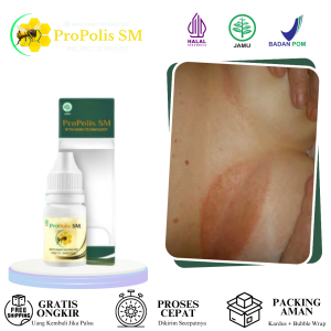 Propolis SM Cair Oles Gatal Lipatan Payudara - Bercak Merah - Infeksi Jamur - Iritasi Kulit - 6 Ml