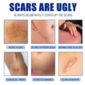 Scar Removal Cream Peklat Remover Cream For Keloid Old Scars Removal Effective Gamot Sa Peklat
