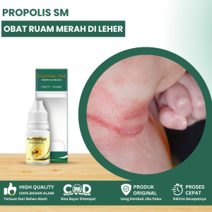 Obat Ruam Merah Di Lipatan Leher Bayi Obat Ruam Merah Pada Bayi Obat Luka Berair Lecet Perih Obat Menghilangkan Bercak Merah Di Merah Obat Beruntusan Pada Bayi Biang Keringat Dengan Propolis SM