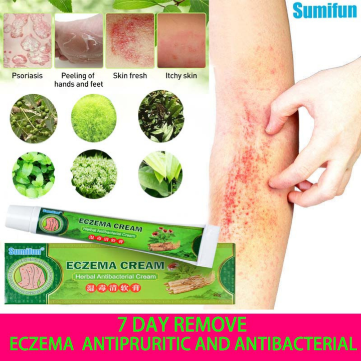 ECZEMA treatment CREAM gamot sa kati kati sa balat anti fungal cream ...