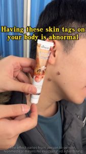 Hot Sale Bee Venom Warts Remover Original Cream Painless Magic Warts Remover No Skin Damage 20g For Face Body Best Value