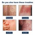 30ml Psoriasis Treatment Spray Hand Foot Scalp Eczema Tinea Anti-itch Rash Urticaria Desquamation Dermatitis Relief Spray. 