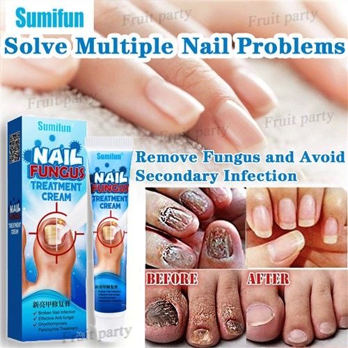 Amorolfine: An antifungal cream used to treat fungal infections of the nails  (onychomycosis) by inhibiting fungal growth Stock Photo - Alamy