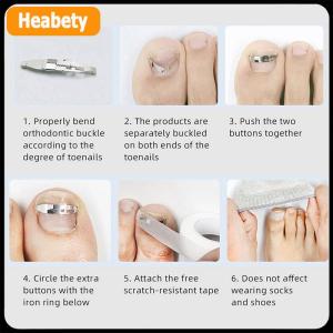 【2-3 days delivery】 Ingrown Toenail Corrector Tools Pedicure Recover Embed Toe Nail Treatment Professional Foot Care Correction Tool Care Foot