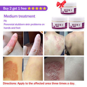 Itchy Hands Itchy Skin Itchy Skin Allergy Mosquito Bites Antiseptic Natural Herbal Zinfandel Antibacterial Antipruritic Cream 30g