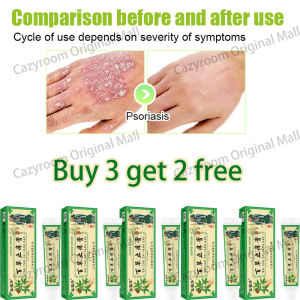 MY 热卖 现货Natural anti itch cream suitable for allergies eczema psoriasis mosquito bites athletes foot blisters skin peeling fungal infections etc. Quick sterilization itching relief and repair.