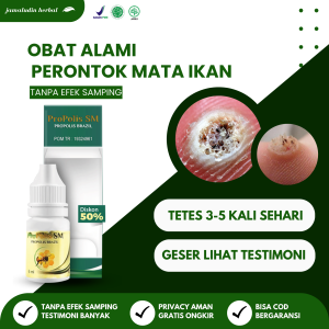 Obat Mata Ikan Pada Kaki Telapak Kaki Jari Tangan Untuk Anak dan Dewasa dengan Propolis SM