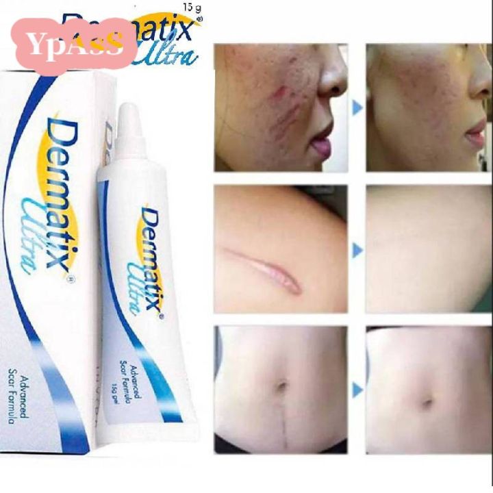 Ypass Dermatix 15G scar silicone gel ointment scars caesarean section