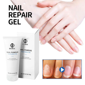 Ouhoe Nail Fungus Treatment Gel Anti Infection Safe Onychomycosis Essence Effective Hand And Foot Care Toe Nail Fungus Moisturizing Vitamin E Foot Care 20g