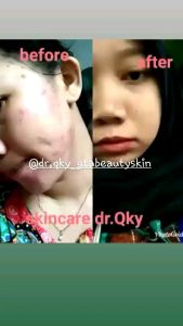 DR.QKY SKINCARE PAKET PIMPLE/ACNE GRATIS LOGAM MULIA