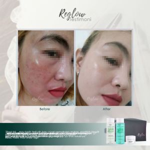 REGLOW - Paket Basic Perawatan Wajah Mencerahkan Wajah Kusam Perawatan Wajah Berjerawat dan Berminyak Krim Pagi Melindungi dari Sinar UV Cream Malam Reglow Toner Glowing Sabun Wajah Serum Perfect Whitening