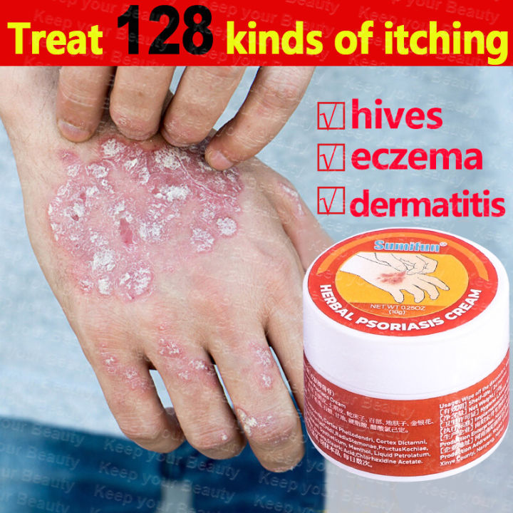 Sumifun Eczema Treatment Cream 20g Psoriasis Treatment Cream Quickly ...