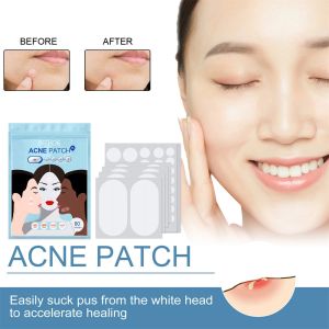 【Natural style】80 Pieces Invisible Acne Removal Patch Anti Acne Pimple Treatment Healing Skin Care Patch