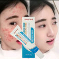 ointment Remover acne pimples Cream Fades Acne Marks Repairs Acne Pits Facial Scar Care remove pimples and dark spots Aloe Gelatine Pimple Eraser Acne Treatment Cream Acne Scar Remover Acne Repair Cream for face whitening cream. 