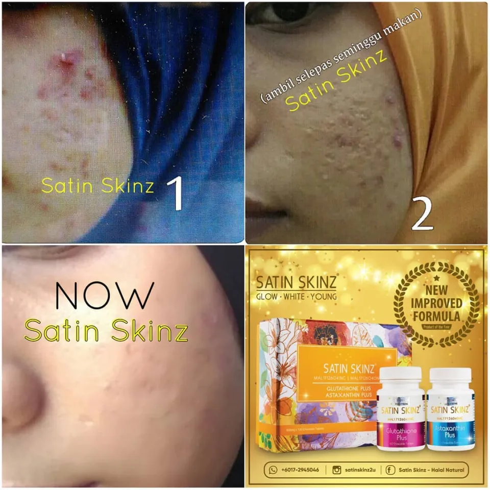 SATIN SKINZ GLUTA TAB.. Skin Whitening Tablet 632 mg GLUTATHIONE & ASTAXHANTIN. Rawat Jerawat Jeragat. Cerahkan Kulit 30 Days Supply Mal17126040Nc - Lazada