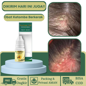 Obat Ketombe Parah Menahun Obat Tetes Ketombe Parah Obat Kulit Kepala Berkerak Obat Ketombe Berkerak Rambut Obat Oles/Tetes Ketombe Berkerak Obat Tetes Ketombe Berkerak Obat Kulit Kepala Gatal Obat Penghilang Jamur Kulit Kepala PROPOLIS SM 100% ASLI