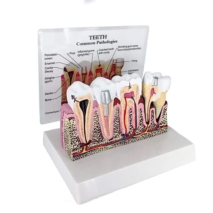 Anatomical Teeth Common Pathologies Model Dental Lab Detachable Dentist ...