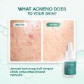 Acneno - Bundle Acne Moist Basic Paket Skincare Acne Serum 12ml & Pelembab Wajah Daily Acne Moisturizer 50g. 