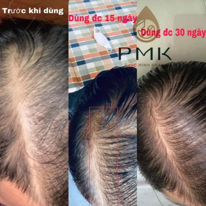 Tinh%20ch%E1%BA%A5t%20m%E1%BB%8Dc%20t%C3%B3c%20cao%20c%E1%BA%A5p%20Ph%C3%BAc%20Minh%20Khang%20k%C3%ADch%20th%C3%ADch%20m%E1%BB%8Dc%20t%C3%B3c-d%C6%B0%E1%BB%A1ng%20t%C3%B3c-h%E1%BA%BFt%20h%C3%B3i%20l%C3%A2u%20n%C4%83m-ki%E1%BB%83m%20so%C3%A1t%20l%C6%B0%E1%BB%A3ng%20d%E1%BA%A7u%20tr%C3%AAn%20da-ph%E1%BB%A5c%20h%E1%BB%93i%20t%C3%B3c%20h%C6%B0%20t%E1%BB%95n-gi%E1%BA%A3m%20stress%20th%C6%B0%20gi%C3%A3n%20tinh%20th%E1%BA%A7n%20Ms.HuyenTrang_NH%20-%20Image%202