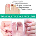 Eelhoe Nail Fungus Solution Nail Fungus Treatment Essence Serum Hand Care Foot Fungal Removal Repair Gel Anti-infective Paronychia Onychomycosis Nail Repair Liquid Nails Solution Fungal Nail Antifungal Anti Fungus Toe Nail Care Hand And Foot Onychomycosis. 