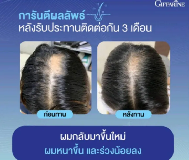 %E0%B9%84%E0%B8%9A%E0%B9%82%E0%B8%AD%E0%B8%95%E0%B8%B4%E0%B8%99%20%E0%B9%80%E0%B8%AD%E0%B8%8A%20%E0%B8%9E%E0%B8%A5%E0%B8%B1%E0%B8%AA%20%E0%B8%81%E0%B8%B4%E0%B8%9F%E0%B8%9F%E0%B8%B2%E0%B8%A3%E0%B8%B5%E0%B8%99%20Biotin%20H%20Plus%20%20%E0%B9%84%E0%B8%9A%E0%B9%82%E0%B8%AD%E0%B8%95%E0%B8%B4%E0%B8%99%20%E0%B9%80%E0%B8%AD%E0%B8%8A%20%E0%B8%9E%E0%B8%A5%E0%B8%B1%E0%B8%AA%20%E0%B9%84%E0%B8%A1%E0%B9%88%E0%B8%AD%E0%B8%A2%E0%B8%B2%E0%B8%81%E0%B9%80%E0%B8%AA%E0%B8%B5%E0%B8%A2%E0%B9%83%E0%B8%88%20%E0%B8%AD%E0%B8%A2%E0%B9%88%E0%B8%B2%E0%B8%9B%E0%B8%A5%E0%B9%88%E0%B8%AD%E0%B8%A2%E0%B9%83%E0%B8%AB%E0%B9%89%E0%B8%8A%E0%B8%B5%E0%B8%A7%E0%B8%B4%E0%B8%95%E0%B8%82%E0%B8%B2%E0%B8%94..%E0%B8%9C%E0%B8%A1%20%20%E0%B8%97%E0%B8%A7%E0%B8%87%E0%B8%84%E0%B8%B7%E0%B8%99%E0%B8%9C%E0%B8%A1%E0%B9%81%E0%B8%82%E0%B9%87%E0%B8%87%E0%B9%81%E0%B8%A3%E0%B8%87%E0%B8%AA%E0%B8%B8%E0%B8%82%E0%B8%A0%E0%B8%B2%E0%B8%9E%E0%B8%94%E0%B8%B5%20-%20Image%207