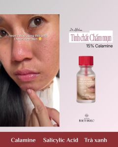 BỘT CHẤM GIẢM MỤN TRỨNG CÁ HIỆU QUẢ DR.ALTHEA 15% CALAMINE SPOT POWDER 15ML HÀN QUỐC - 19634 - Làm xẹp và giảm sưng đỏ các nốt mụn bọc mụn mủ mụn sưng v diện rộng một cách nhanh chóng. ■ Hút sạch dịch mụn và bã nhờn dư thừa thúc đẩy cồi mụn tự chín v
