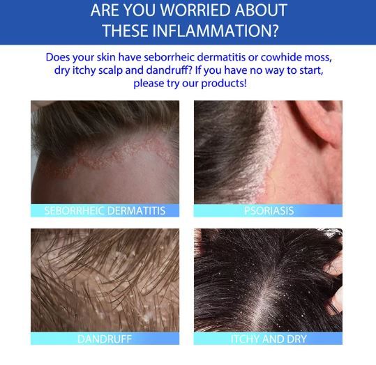 Seborrheic Dematitis Antibacterial Cream Anti Dandruff Scalp Treatment ...