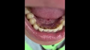 Probiotic Toothpaste Whitening Cleaning Teeth Remove Tartar Sn Removal for Teeth Fresh Breath