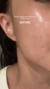 Tinh chất chai màu xanh nhỏ TAKAMI Skinpeel Essence 30ML