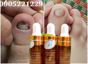 Serum đánh bay nấm móng hư khoé bọng móng nước ăn tay chân gia truyền 4ml