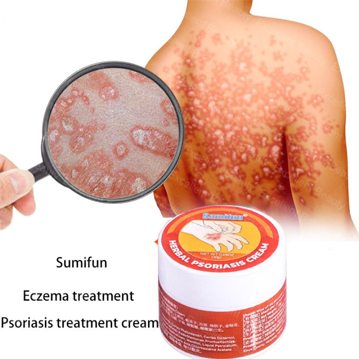 100% ORIGINAL & EFFECTIVE Sumifun Herbal Psoriasis Dermatitis Eczema ...