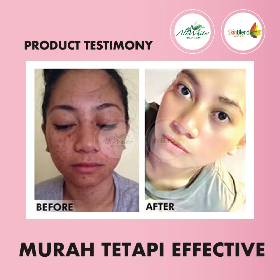 all white glutathione herbal lightening soap ALLWHITE Glutathione Herbal Lightening Soap Sabun Pure Face Soap Organic  Whitening Coconut Soap KKM APPROVAL Vitamin C And E Face Soap Acne Problem  Solution Soap - Lazada
